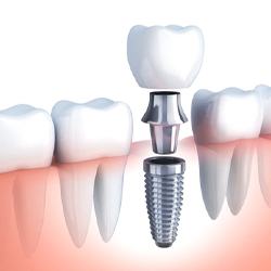 diagram of dental implants in Lisle