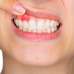 Closeup of smile with gum disease