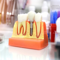 Model for holding dental implants in Lisle