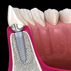 Diagram of a dental implant integrated inside of the jawbone