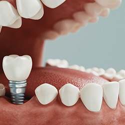 Diagram showing a dental implant in Lisle inside the mouth