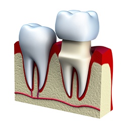Animation of tooth with dental crown