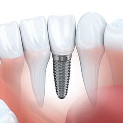 Animation of implant supported dental crown