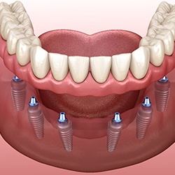 A 3D illustration of implant dentures