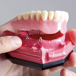 Model of implant supported denture