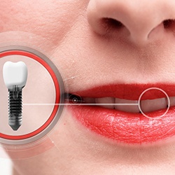 Smile with a dental implant in the upper arch