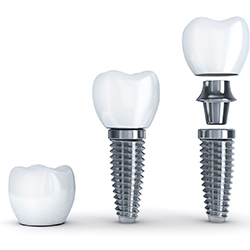 Crown, implant post, and titanium abutment
