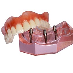 Model for implant dentures in Lisle, IL