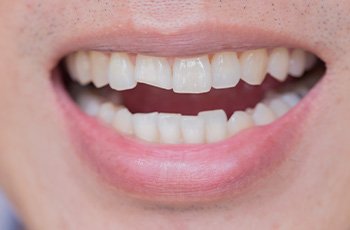 Our dentists near Downers Grove can help repair a broken tooth