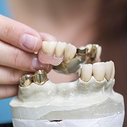 Model smile wiht implant retained partial denture