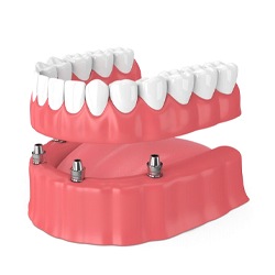 implant-retained dentures on bottom arch