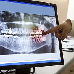 Full dental x-rays on computer