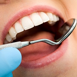 Closeup of teeth during dental exam