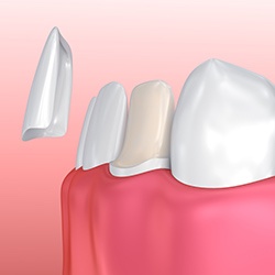 Animation of porcelain veneer placement