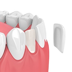 Model of a veneer in front of a tooth.