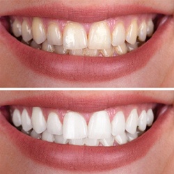 before and after teeth whitening 