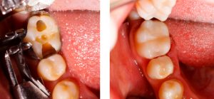 Tooth filling by dentist