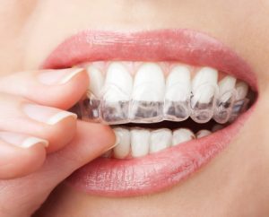 woman puting in alignment tray from Invisalign in lisle