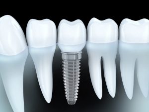 Dental implants in Lisle look and act like real teeth, but their success depends on after care. Lisle dentist, Dr. Frank Marchese, explains how it’s done.