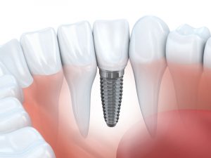 Dental implants in Lisle are a superior solution. 