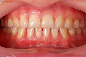 A photo of healthy gums.