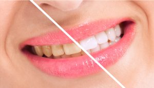 bleaching teeth whitening