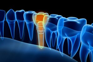 Computer model of a dental implant