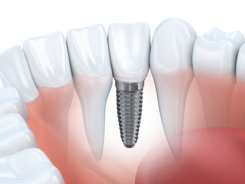 Learn About the Materials Used in Dental Implants in Lisle