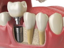 3D model of an implant in the lower jaw 