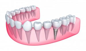 a dental implant