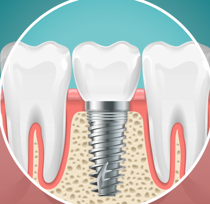 Illustrated cross section of a dental implant